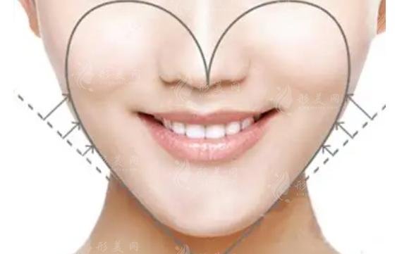 哪些人適合豐蘋果肌？用玻尿酸填充好還是自體脂肪填充果好？