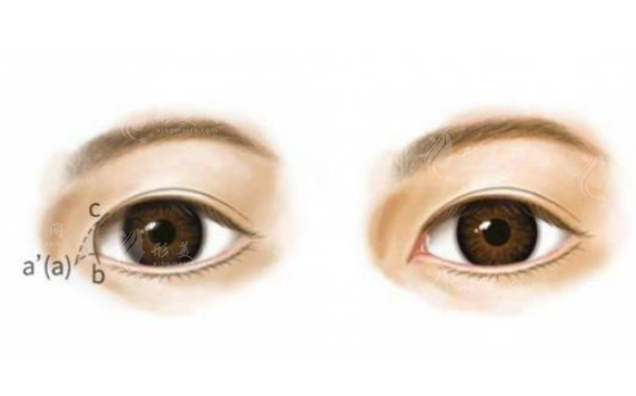 內(nèi)眥贅皮一定要開眼角嗎？收費價格貴嗎？