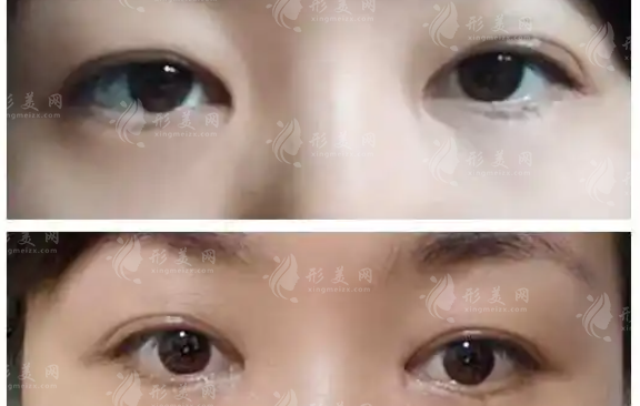 內(nèi)眥贅皮術(shù)會留疤嗎？需要多少錢？