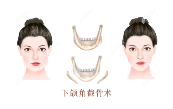 下頜角整形