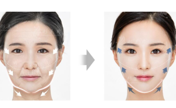 面部提升可以維持多久？有副作用嗎？