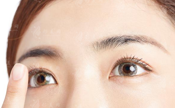 ＂埋線＂雙眼皮幾年后會消失，真的是這樣嗎？