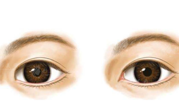 開眼角手術(shù)有哪些好處？4大好處讓意想不到！