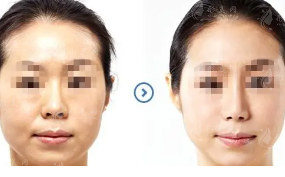 激光除皺手術(shù)有什么優(yōu)勢？激光除皺的原理是什么？