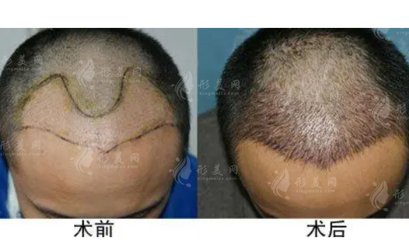 頭發(fā)移植效果能保持多久？手術(shù)有危險(xiǎn)嗎？