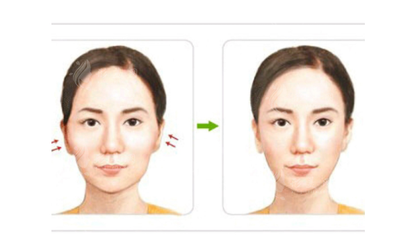 顴骨縮手術(shù)多少錢？手術(shù)危險嗎？