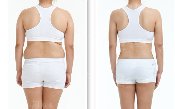 水動力吸脂和負壓吸脂哪個好？有哪些區(qū)別？