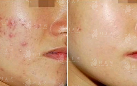 紅藍(lán)光祛痘多久做一次？可以根治嗎？