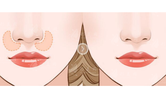 墊鼻基底用什么材料效果好？會有副作用嗎？