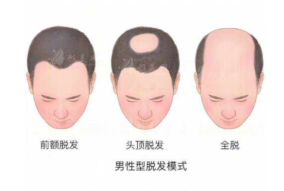 上海第九人民醫(yī)院植發(fā)掛什么科？多少錢(qián)？附吳巍醫(yī)生介紹