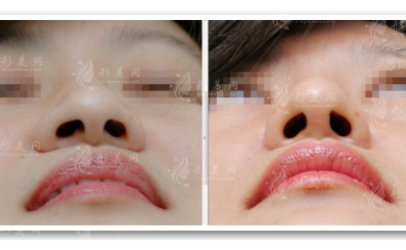 縮鼻翼手術(shù)需要多少錢？風(fēng)險(xiǎn)大嗎？