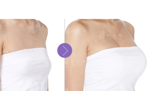 自體脂肪豐胸手術(shù)費(fèi)大概要多少錢？副作用和危害有哪些？