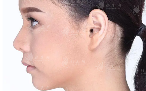 耳廓畸形矯正費(fèi)用多少錢？注意事項(xiàng)有哪些？