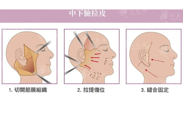 廣州排名前十醫(yī)院拉皮手術(shù)價格一覽表