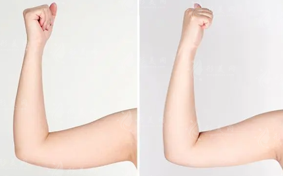 水動(dòng)力吸脂一般需要多少錢(qián)？手術(shù)效果有保障嗎？