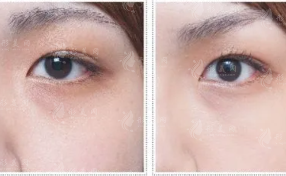 光子去黑眼圈多少錢？項目對眼睛有害嗎？