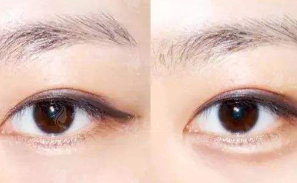 膠原蛋白豐臥蠶多少消腫？材料有副作用嗎？