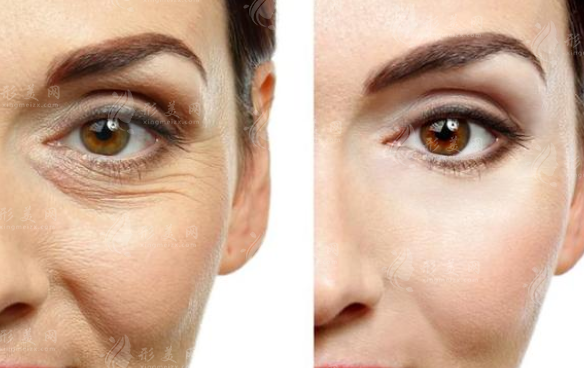 面部拉皮手術(shù)能保持多久？有風(fēng)險(xiǎn)嗎？