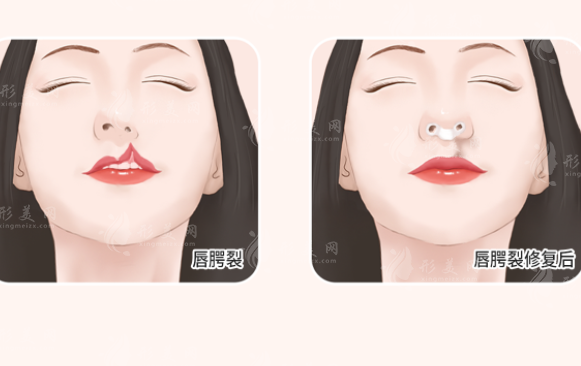 唇腭裂修復(fù)注意事項(xiàng)有哪些？有副作用嗎？