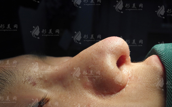 鼻翼缺損矯正大概需要多少錢？會(huì)有副作用嗎？