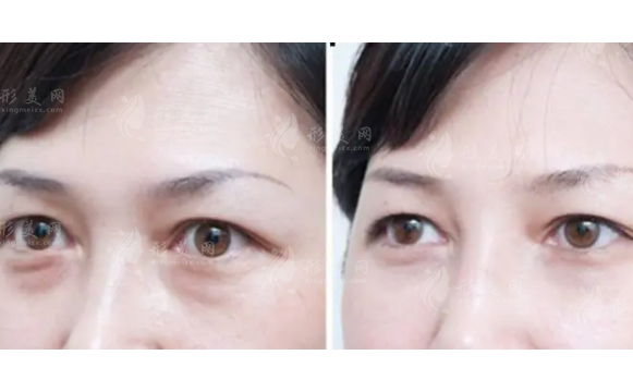 超聲波去眼袋一般多少錢？效果能維持多久？