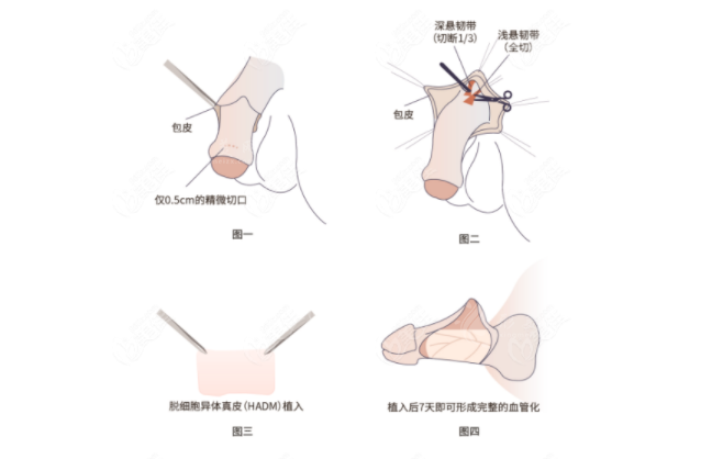 李世榮醫(yī)生做延長(zhǎng)增粗手術(shù)怎么樣？