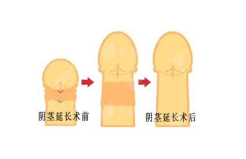 重慶星榮整形醫(yī)院李世榮做延長(zhǎng)手術(shù)厲害嗎？提升持久延長(zhǎng)+增粗