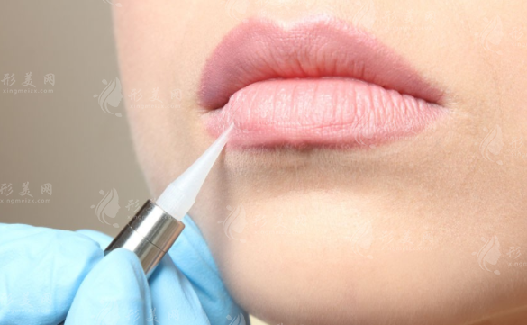 厚唇改薄多久完全恢復(fù)？手術(shù)風(fēng)險大嗎？