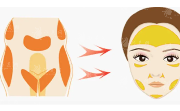 自體脂肪填充面部能保持多長時間？術(shù)后注意事項有哪些？