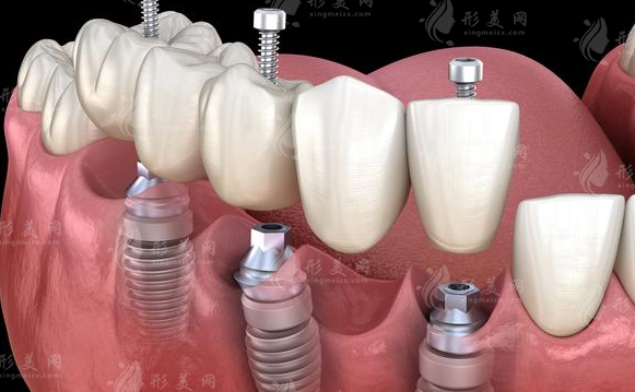 上海九院種植牙技術怎么樣？醫(yī)生名單&牙齒案例&價格費用2024