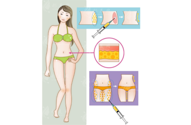 廣州軍美王世虎做吸脂怎么樣？