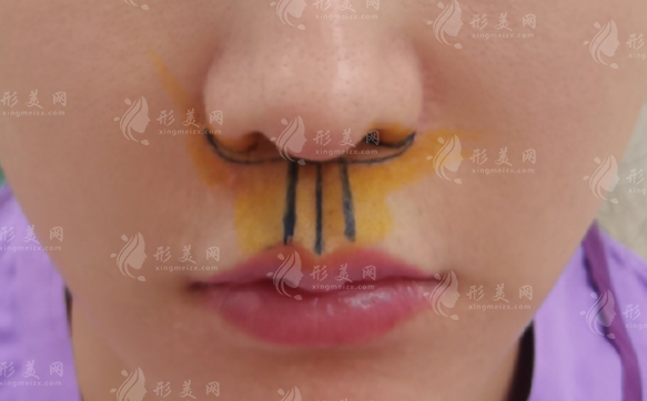 人中縮短術(shù)為什么不建議？除了手術(shù)還有別的辦法嗎？