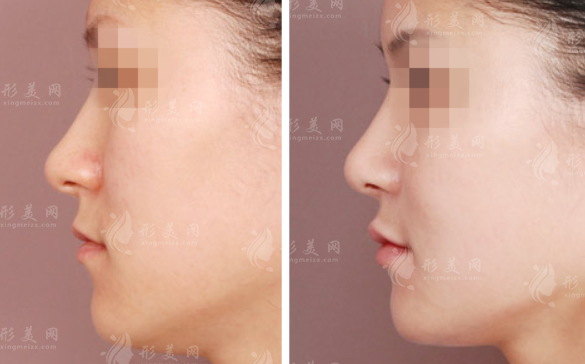 隆鼻修復(fù)多久才能二次修復(fù)？取出后可以馬上手術(shù)嗎？