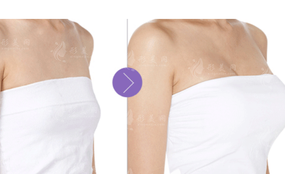 假體隆胸or自體脂肪隆胸，究竟應(yīng)該怎么選？