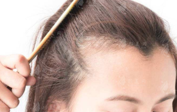 發(fā)際線(xiàn)高要怎么改善？植發(fā)一般要多少錢(qián)？