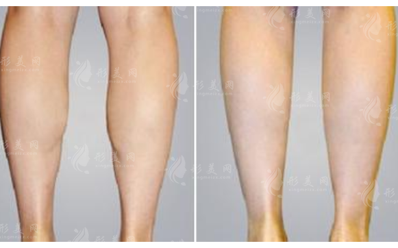 做腿部吸脂老了會怎么樣？皮膚會松弛嗎？