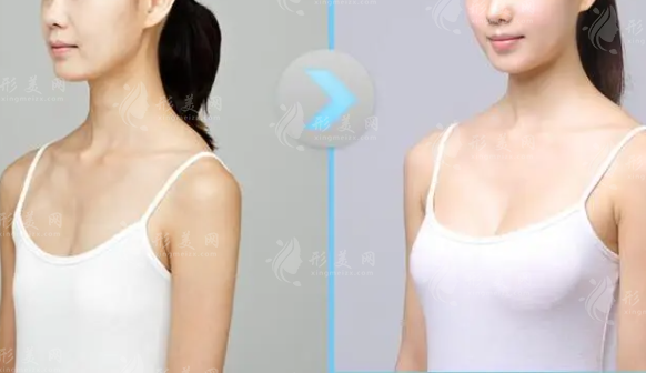 多內(nèi)窺鏡隆胸少錢(qián)?由什么決定?