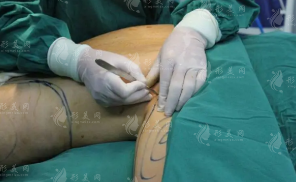 吸脂手術(shù)和抽脂手術(shù)區(qū)別是什么？