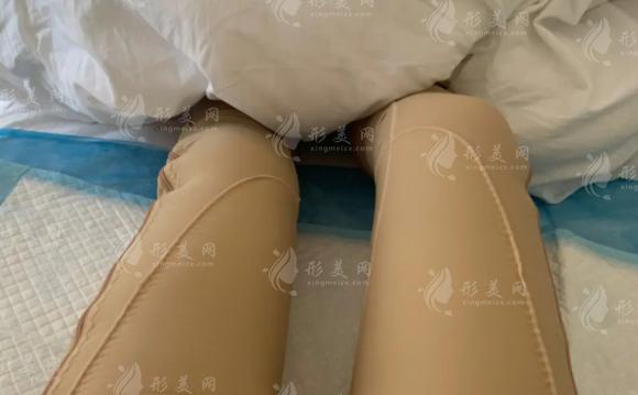 大腿吸脂恢復(fù)時間是多久?術(shù)后護(hù)理小知識~ 大腿吸脂恢復(fù)時間是多久?術(shù)后護(hù)理小知識~