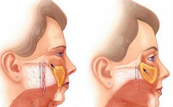 大拉皮手術(shù)能維持多久?如何護理小秘招~ 大拉皮手術(shù)能維持多久?如何護理小秘招~