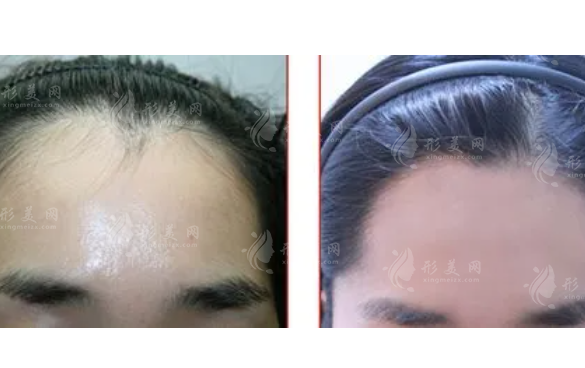 FUT植發(fā)需要多少錢?術(shù)后還會脫發(fā)嗎？