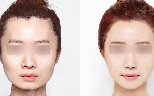 磨骨瘦臉效果怎么樣?多久才能恢復(fù)自然？