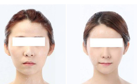 顴骨內(nèi)推術(shù)是長期的嗎？附手術(shù)相關(guān)知識