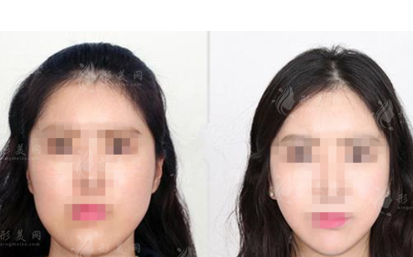 顴骨內(nèi)推術(shù)后沒戴頭套，會(huì)發(fā)生什么事?會(huì)影響術(shù)后效果嗎~