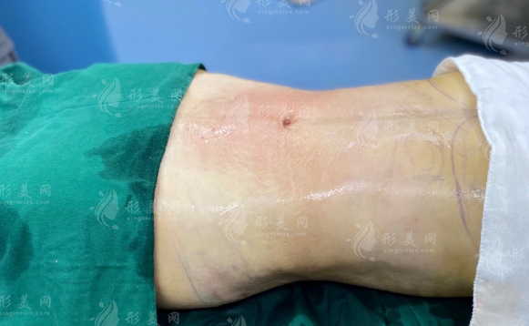 腰腹環(huán)吸多久可以上班，瘦的太理想了