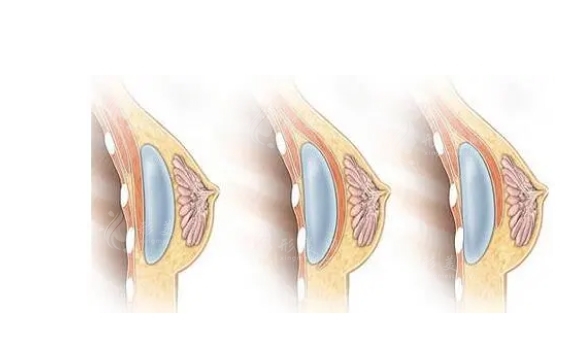 假體隆胸恢復(fù)期是多久?觸感真實(shí)嗎?