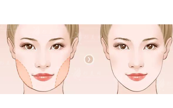 咬肌切除手術(shù)費(fèi)用是多少？價(jià)格貴嗎？