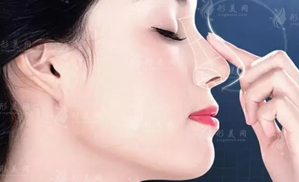 注射隆鼻好還是做假體好？內(nèi)附手術(shù)介紹
