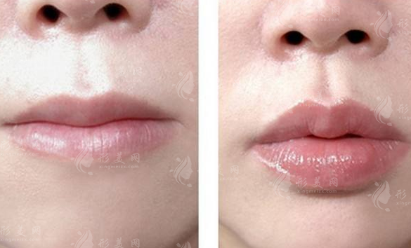 玻尿酸豐唇術(shù)整形有副作用嗎? 玻尿酸豐唇術(shù)整形有副作用嗎?