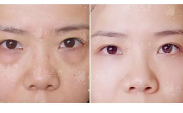 去眼袋手術(shù)效果好嗎?會(huì)不會(huì)反彈?